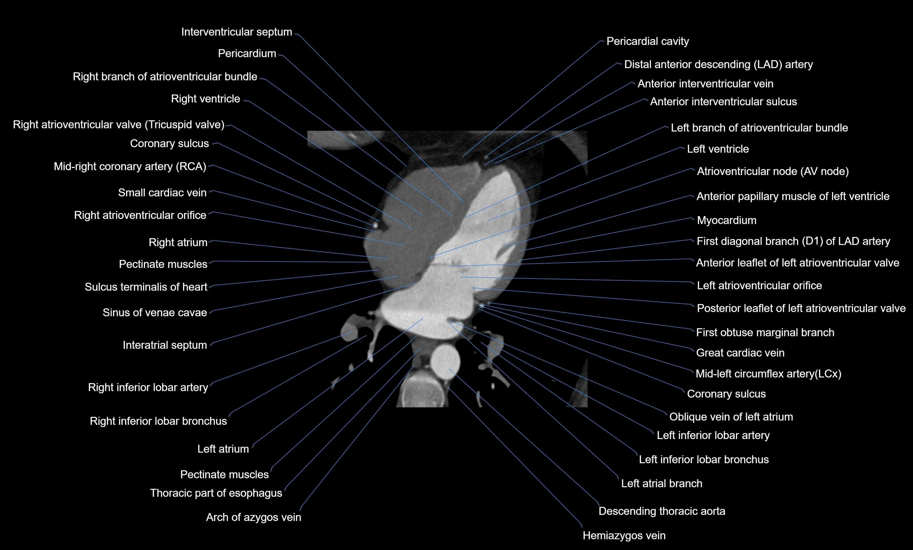 CT heart (coronary angiogram) four chamber view  cross sectional anatomy labelled radiology image -00030.webp